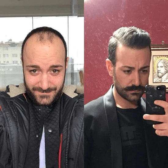 Q6 base Men's Non Surgical Hair Replacement  Swiss Lace With Skin Poly Back and Middle Best for Gym（Buy One, Get One Free ）