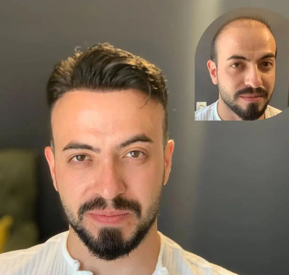 Hollywood Base Hair System for Men  Full Lace in Center with 1'' Thin Skin Around and 1/2'' Lace in the Front