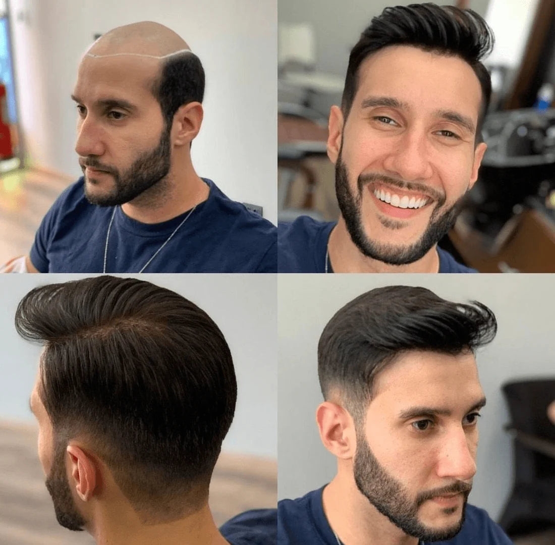 Full Germany LaceA durable, stable, and natural-looking lace base with a 120%–130% high-density hair option for a fuller hairstyle